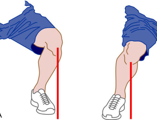Why is there a tendency to valgus in squats?
