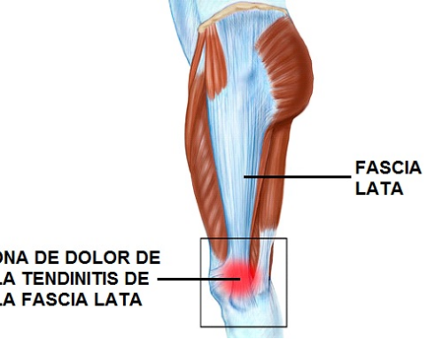 ¿Siente dolor en la región lateral de la pierna? Puede ser tendinitis de la fascia lata