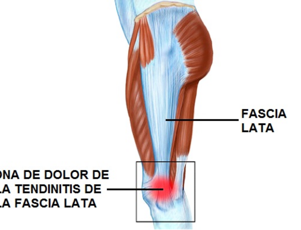 Собственная фасция бедра. Fascia lata анатомия. Широкая фасция бедра анатомия. Musculus Tensor fasciae Latae, напрягатель широкой фасции. Фасцию бедра, fascia lata.